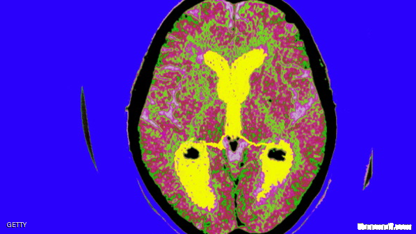 فقدان الذاكرة ليس مؤشرا أكيدا على الزهايمر