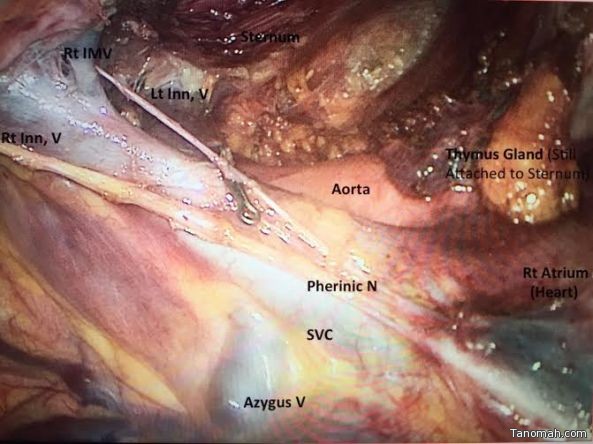 استئصال الغدة الثيموسية بمنظار الصدر لسيدة عشرينية