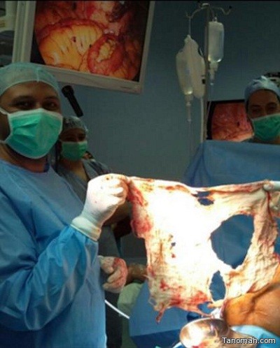 الجوف: استخراج قطعة شاش بقيت في بطن مريض 4 سنوات بسبب خطأ طبي خارج المملكة (صورة)