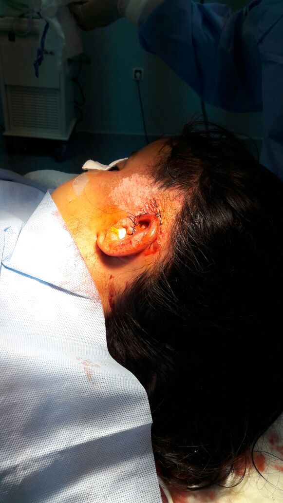 بعد تعرضها لحادث دهس: فريق طبي بمستشفى #بللحمر ينجح في إعادة اذن طفلة لوضعه الطبيعي