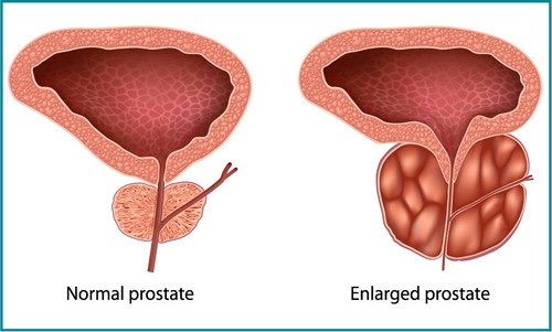 تضخم البروستاتا الحميد